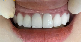 Lợi ích và ưu điểm của việc làm răng sứ ?
