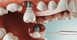 Tìm hiểu về qui trình trong răng Implant và lợi ích của nó ?