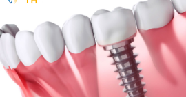 5 lợi ích tuyệt vời khi trồng răng Implant