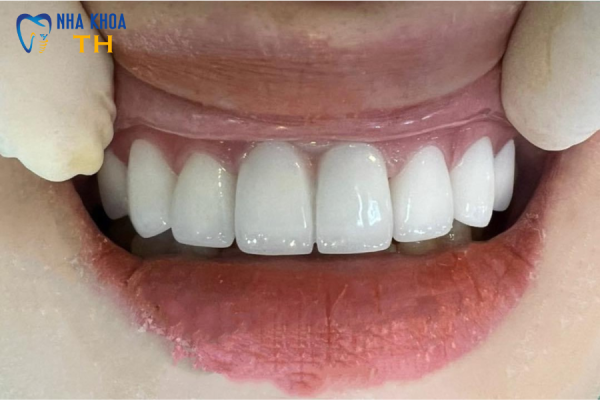 Kiến Tạo Nụ Cười Hoàn Hảo Sau 24 Giờ Tại Nha Khoa TH 3 Kiến Tạo Nụ Cười Hoàn Hảo