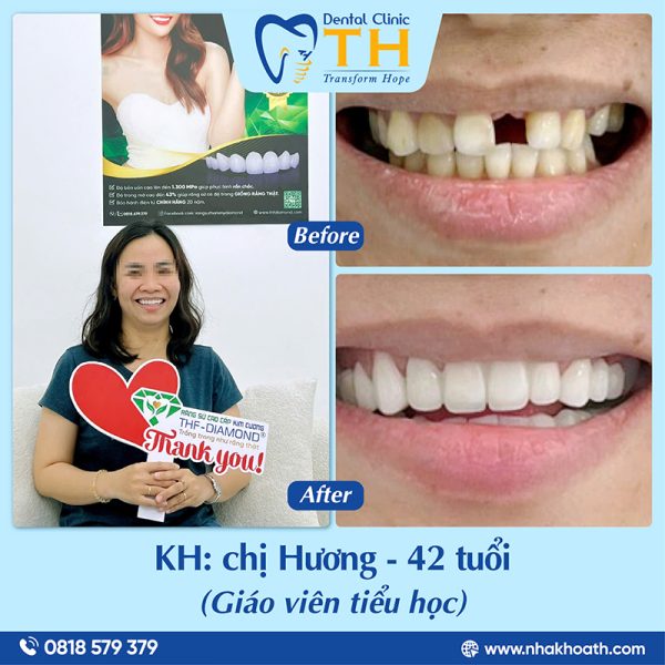 Làm Răng Sứ Tại Nha Khoa TH