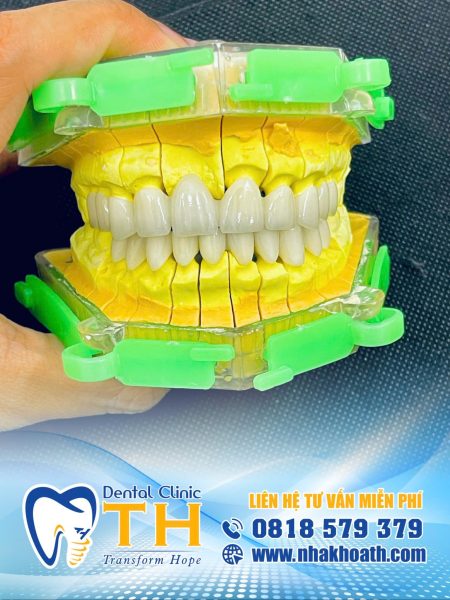 Nha khoa TH – Địa Chỉ Bọc Răng Sứ Cao Cấp Uy Tín Tại TP.HCM 2 boc răng sứ tại nha khoa TH