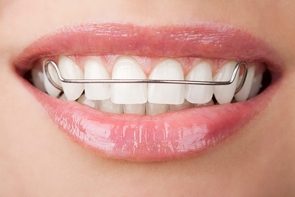 Hàm Duy Trì Cố Định – Chìa Khóa Bảo Vệ Kết Quả Chỉnh Nha 3 Lưu ý khi dùng hàm duy trì cố định