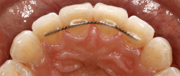Hàm Duy Trì Cố Định – Chìa Khóa Bảo Vệ Kết Quả Chỉnh Nha 2 Hàm duy trì cố định