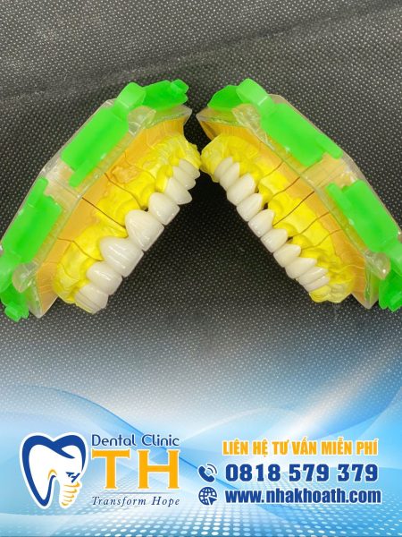 Nha khoa TH – Địa Chỉ Bọc Răng Sứ Cao Cấp Uy Tín Tại TP.HCM 3 địa chỉ bọc răng sứ