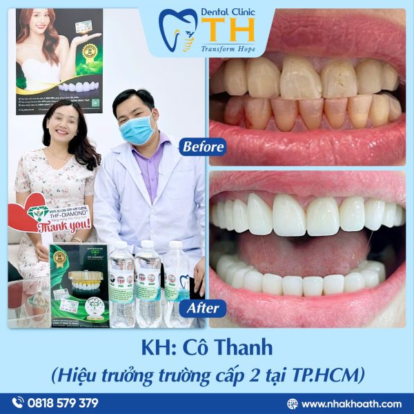 làm răng sứ THF - DIAMOND