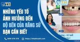 Những Yếu Tố Ảnh Hưởng Đến Độ Bền Của Răng Sứ Bạn Cần Biết