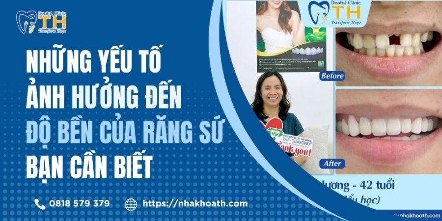 Những Yếu Tố Ảnh Hưởng Đến Độ Bền Của Răng Sứ Bạn Cần Biết
