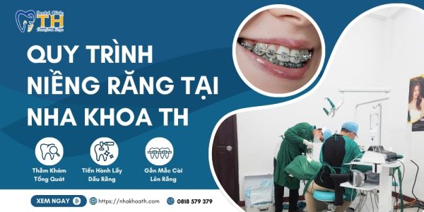 quy-trinh-nieng-rang-tai-nha-khoa-th-1