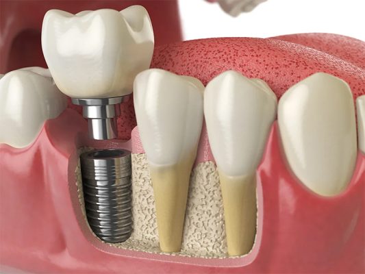Trồng Răng Implant Là Gì? Tìm Hiểu Toàn Diện Về Giải Pháp Phục Hình Răng Hiện Đại 2 trong-rang-implant