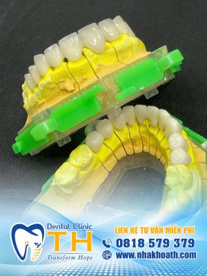 Bọc Răng Sứ Tại Nha Khoa TH