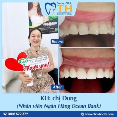 Khách Hàng Bọc Răng Sứ Tại Nha Khoa TH
