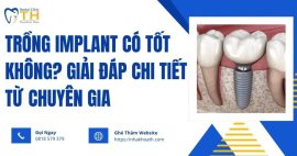 trong-implant-co-tot-khong-giai-dap-chi-tiet-tu-chuyen-gia