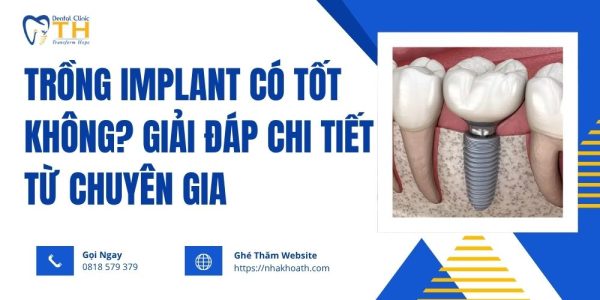 trong-implant-co-tot-khong-giai-dap-chi-tiet-tu-chuyen-gia