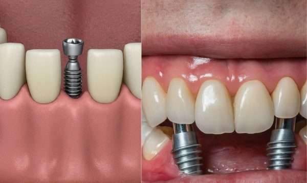 Trồng Răng Implant Nha Khoa TH