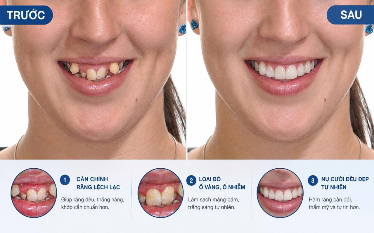 Chỉnh răng lệch lạc